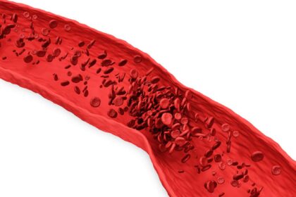 Φλεβική θρόμβωση και πνευμονική εμβολή Euromedica Γενική Κλινική